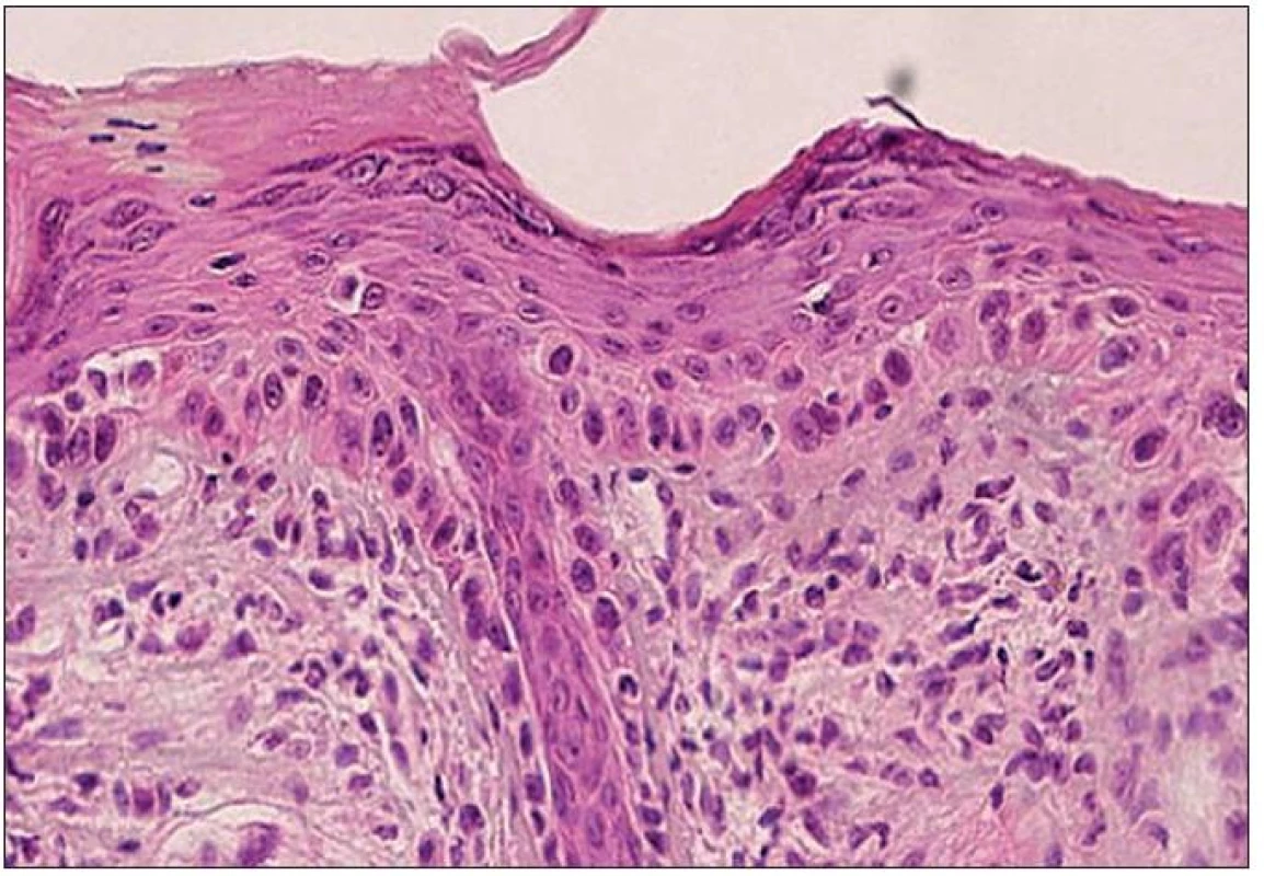 Atrofický typ AK – atroficky zmenená epiderma s fokálnou nevýraznou hyperkeratózou na povrchu. Atypické keratinocyty postihujú štruktúry vlasového folikulu (H&amp;E, 400x).