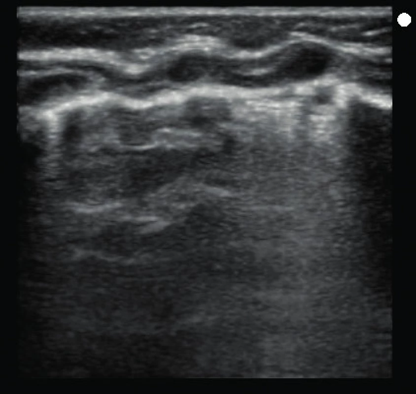 USG obraz pľúc v pravom hornom kvadrante (D1) u tej istej pacientky ako na obrázkoch 1 a 2, získanom lineárnou sondou. Pomocou tejto sondy získavame najkvalitnejší záznam z blízkosti pleurálnej línie, jednoznačne dokážeme identifikovať subpleurálne konsolidácie (foto archív KDAIM).
Fig. 3. Image of LUS in same zone in same patient as in previous figures (1 and 2) by linear probe. Best quality image with details in area of pleural line, reliably identified subpleural consolidations (archive KDAIM).