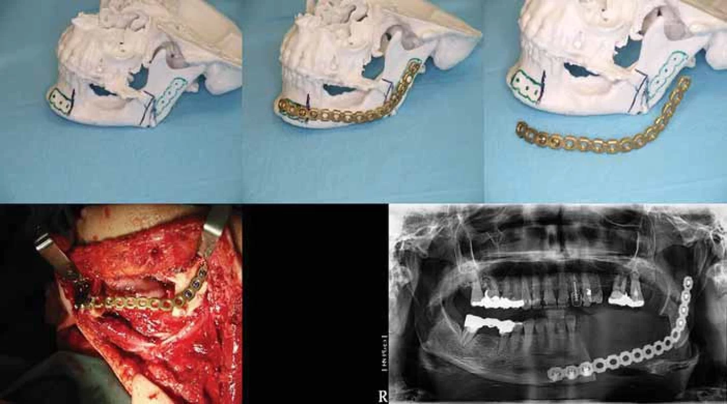 First true 3D assisted surgery, a lateral mandibular body resection and preshaped load bearing reconstruction plate; upper row