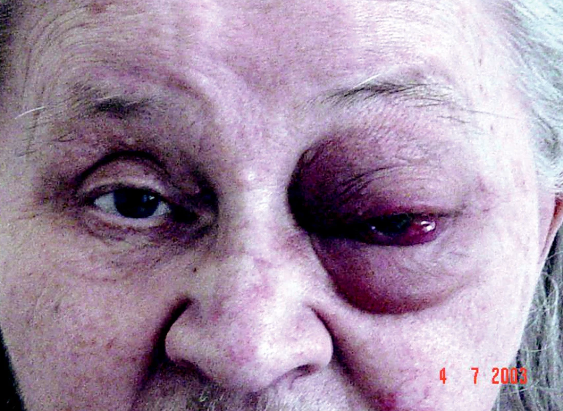 Ľavé oko v protrúzii, výrazný periokulárny edém, chemóza spojovky