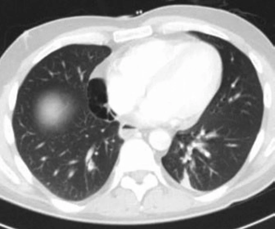 CT, transverzální řez, plicní okno. Pneumomediastinum mezi pravou plící a pravou srdeční síní.