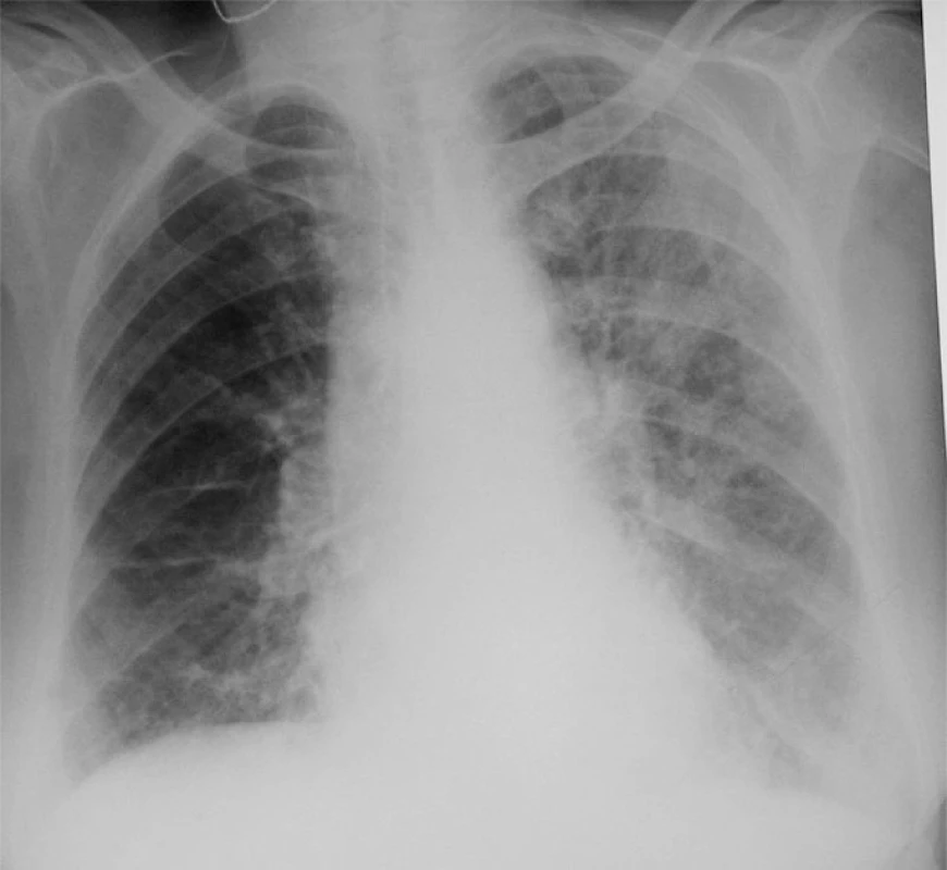 Reinfekce Chlamydií pneumoniae u starší pacientky. Difúzní retikulonodulární kresba oboustranně, v horní polovině levého plicního pole splývající cárovité stíny.