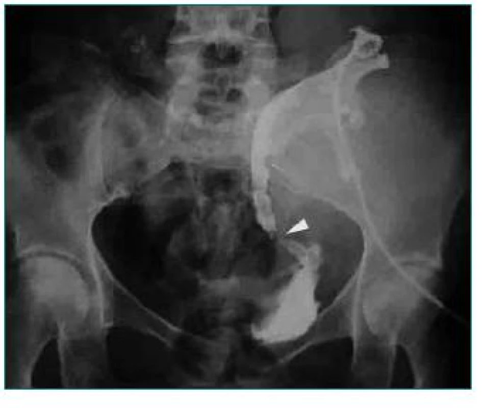 Urinózna fistula podmienená nekrózou močovodu transplantovanej obličky.