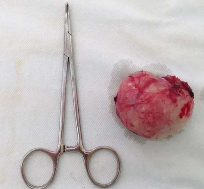 Excidovaný leiomyom močového měchýře – preparát
Fig. 4. Excised tumor – specimen