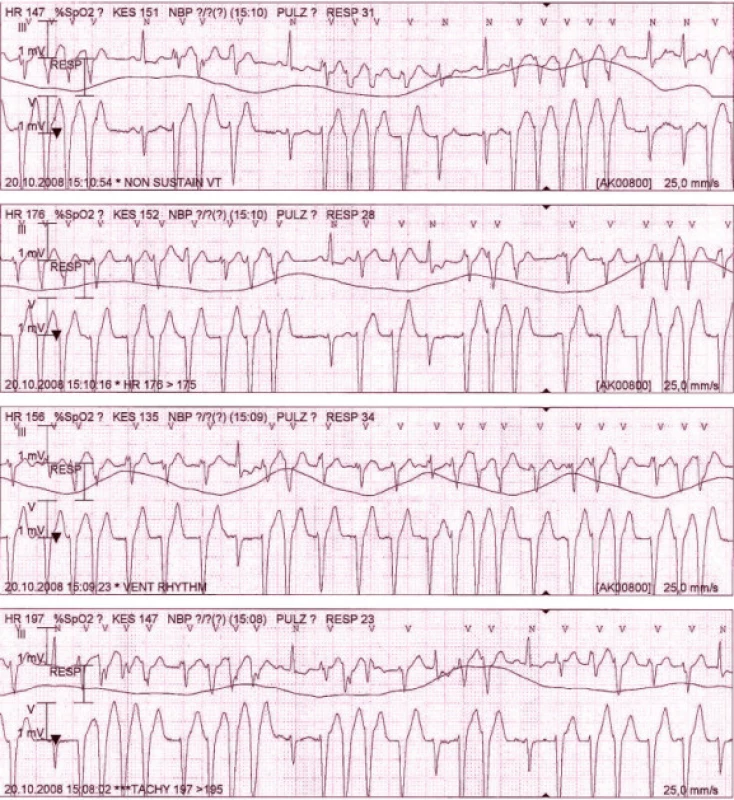 Záznam monitorace z 5svodového EKG během hospitalizace na jednotce intenzivní péče: kuplety a triplety komorových extrasystol až běhy nesetrvalé monomorfní komorové tachykardie, jen ojedinělé sinusové komplexy.