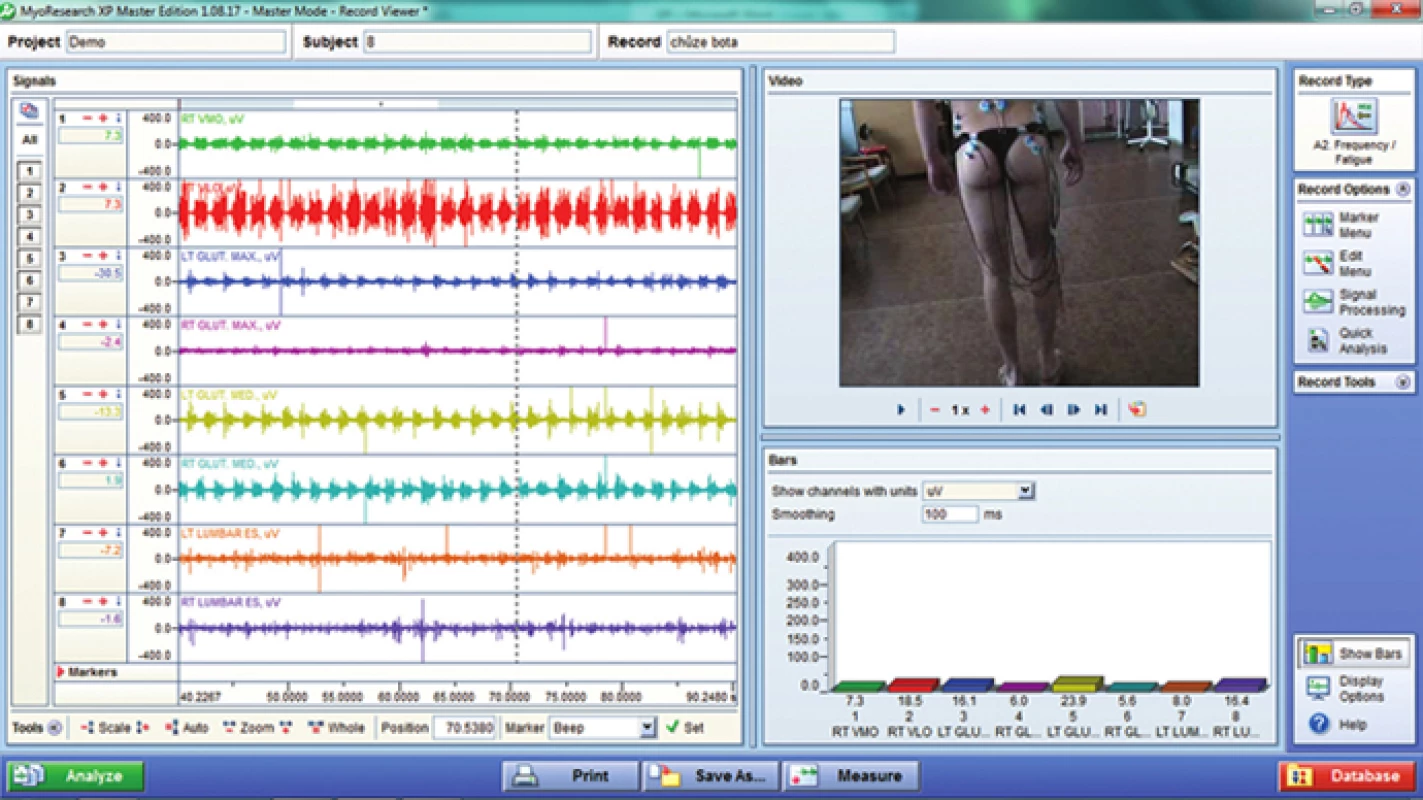 Ukázka EMG záznamu při cviku v balančních sandálech.