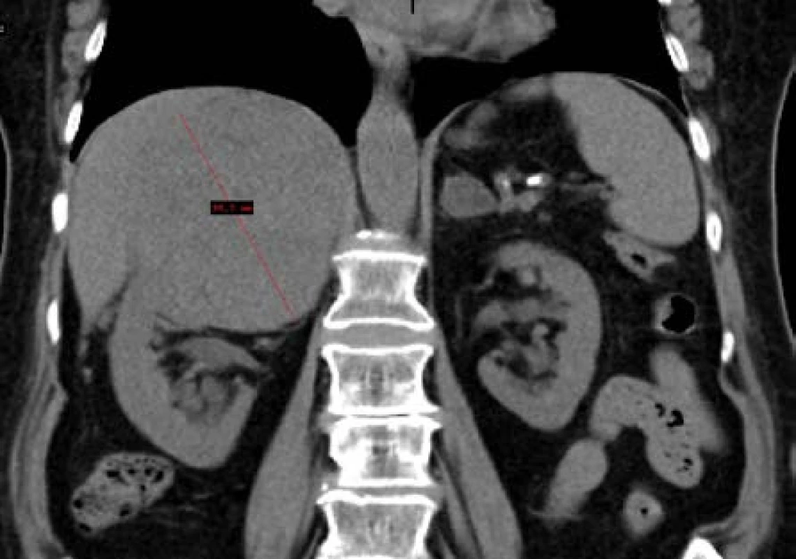 Lymfom pravé nadledviny CT vyšetření
Fig. 2. Lymphoma of the right adrenal gland in CT imaging