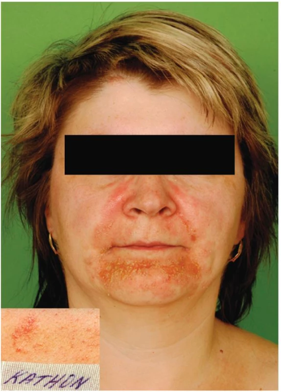 Eczema contactum – Kathon CG (šampony a další)
Epikutánní test – alergická reakce na Kathon CG