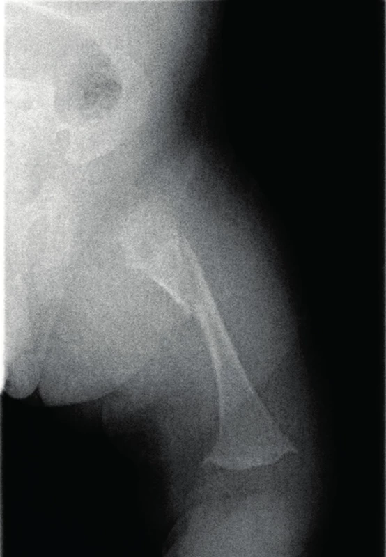 Fraktura pravého femuru jako následek metabolického kostního onemocnění při nezralosti.
Fig. 2. Fracture of the right femur as a result of metabolic bone disease of prematurity.