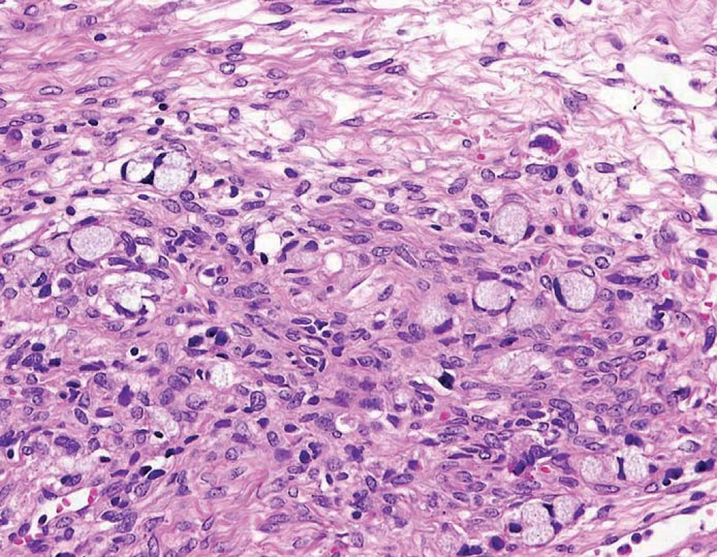 HE (hematoxin-eozin) barvený vzorek GCC – pohárkové buňky s nálezem buněk tvaru pečetního prstenu a extracelulárními ostrůvky mucinu.