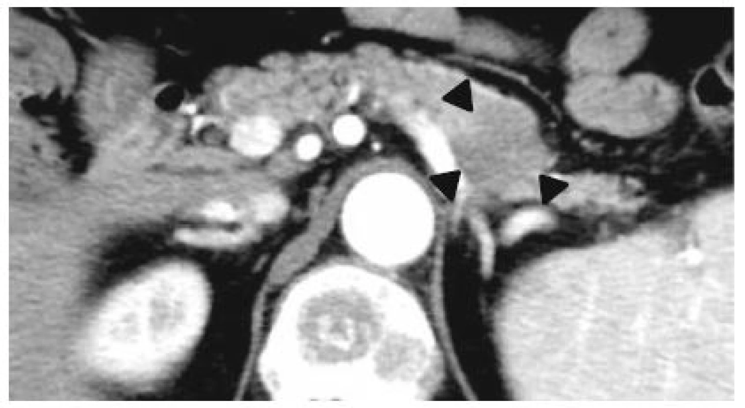 Contrast-enhanced whole-body CT image. A tumor of approximately 28 mm in diameter with poor enhancement was detected in the tail of the pancreas (black arrowheads)