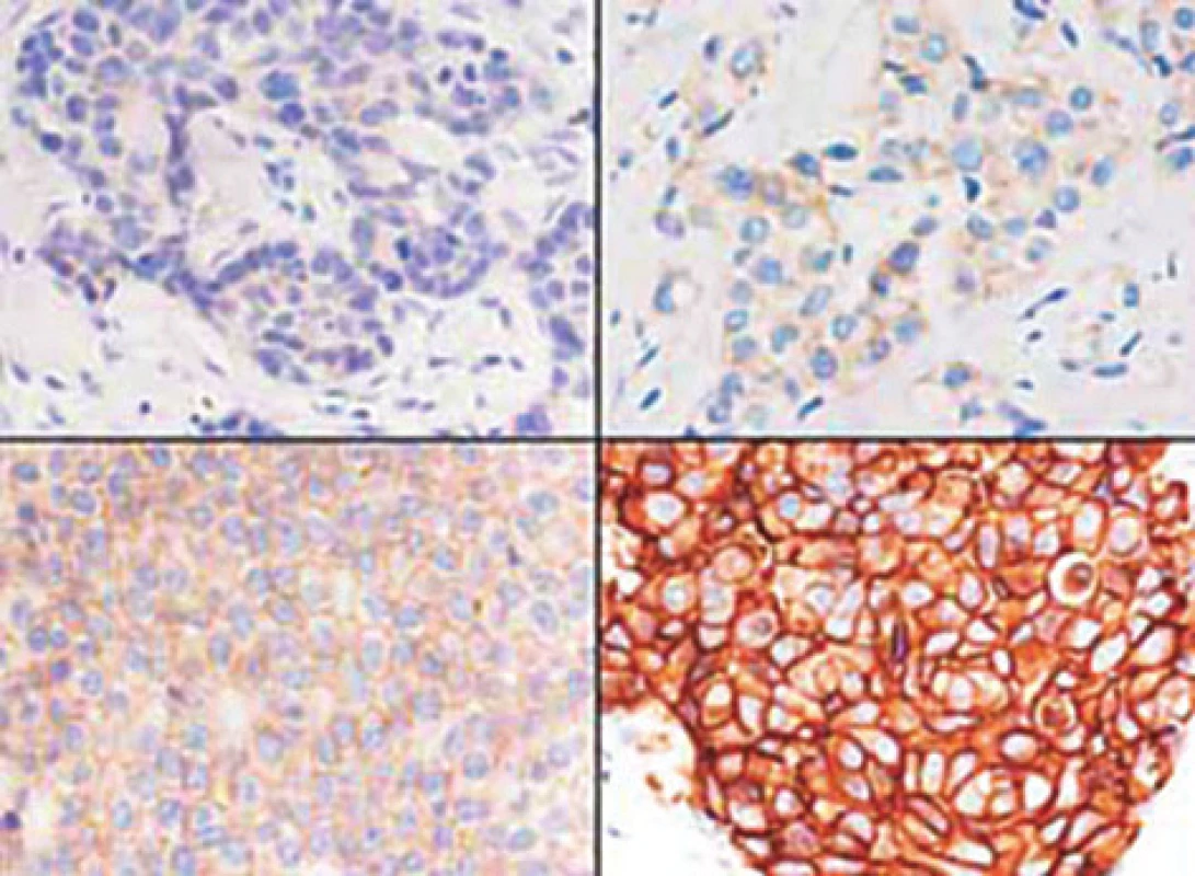 Stupně exprese proteinu HER-2/neu při imunohistochemickém vyšetření certifikovaným kitem – typické obrazy exprese 0, 1+, 2+ a 3+ (dle www.patologie.info.cz)