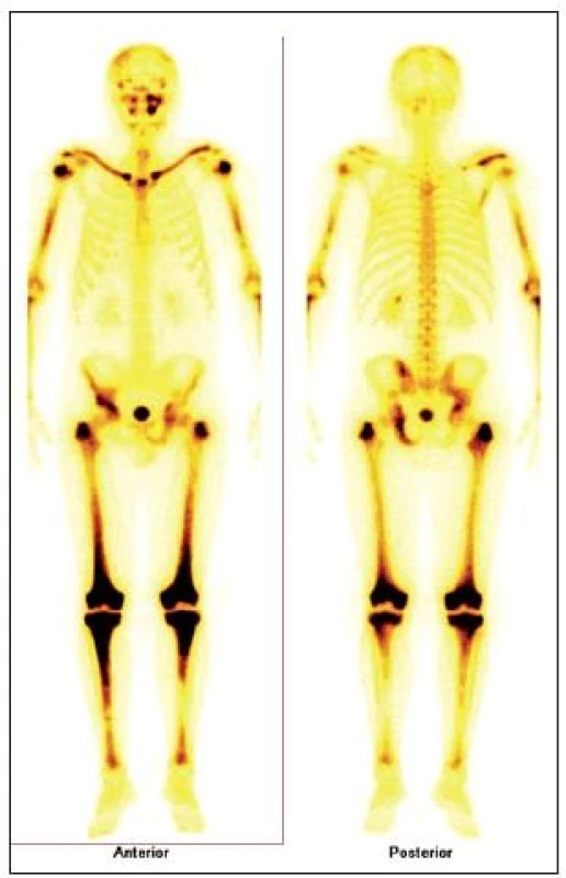 Scintigrafie skeletu u pacienta s Erdheimovou-Chesterovo u chorobou. Scintigrafie skeletu: zvýšená aktivita radiofarmaka je vidět hlavně ve dlouhých kostech – oba humery ve střední třetině, v distálních částech obou femorů, v proximálních částech obou tibií, v obou klavikulách, v oblasti pánve – os ischii vlevo, os pubis vpravo, os ilium vpravo, v oblasti levého SI skloubení, dále v oblasti maxily vlevo, difuzně vyšší aktivita v oblasti kalvy s ložisky vpravo parietálně a částečně frontálně bilat.
