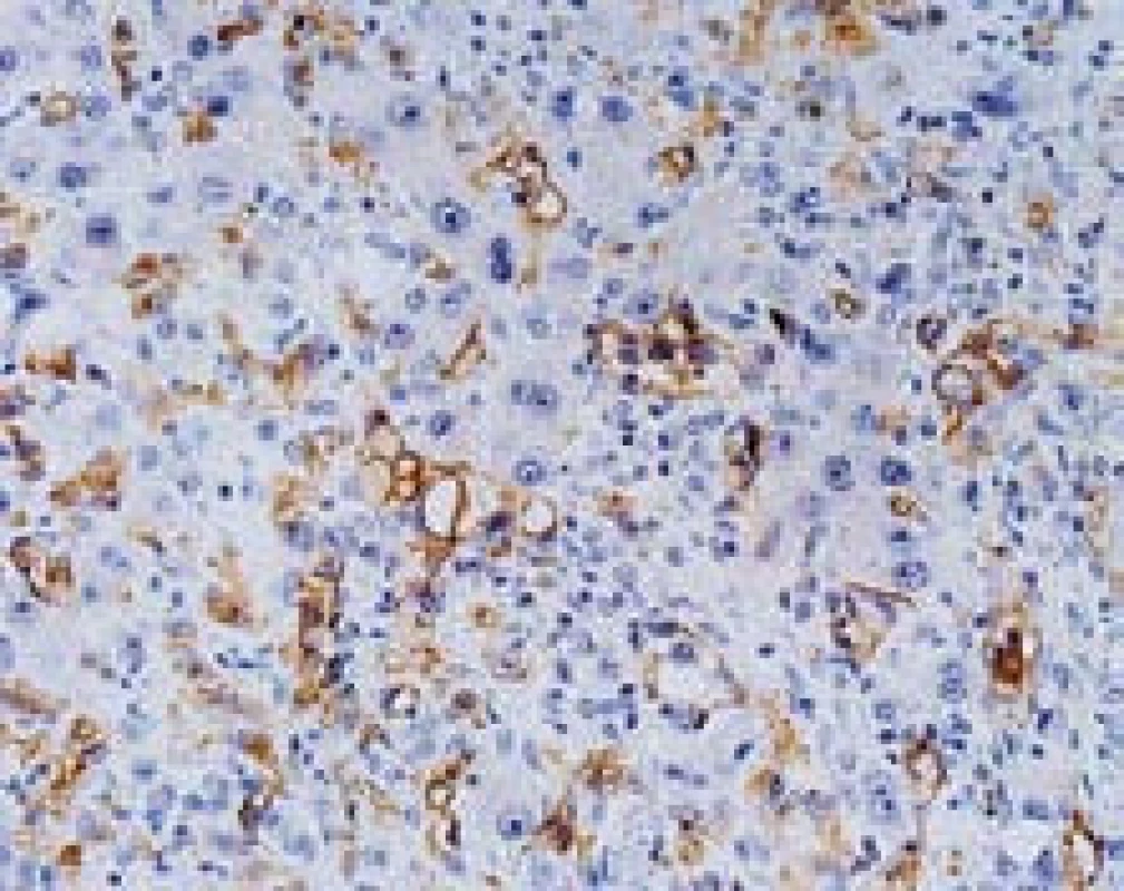 Epiteloidní hemangioendoteliom, imunohistochemický průkaz CD34 verifikuje endotel sinusů (nenádorový i nádorový), s pozitivními elementy šířícími se sinusy. Současně jsou dobře patrné cytologické reaktivní změny hepatocytů. Zvětšení objektiv 40×.
Fig. 6. Epithelioid hemangioendothelioma, immunoperoxidase detection of CD34 with positive staining in the endothelium (benign and malignant) with tumor cells spreading in the sinusoids. Reactive changes of hepatocytes are also shown, high power field.