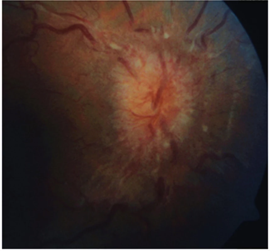 Terč zrakového nervu při prvním vyšetření na pravém oku
