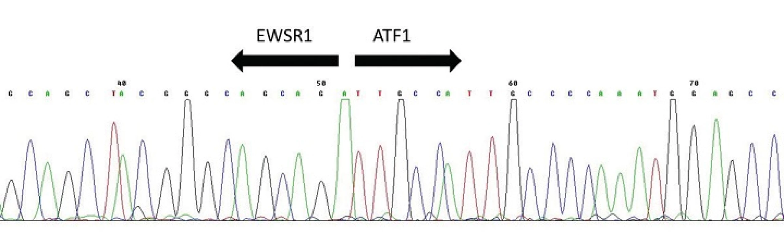 Sekvenogram fúzního transkriptu &lt;i&gt;EWSR1-ATF1&lt;/i&gt;. Šipky vyznačují místo fúze.