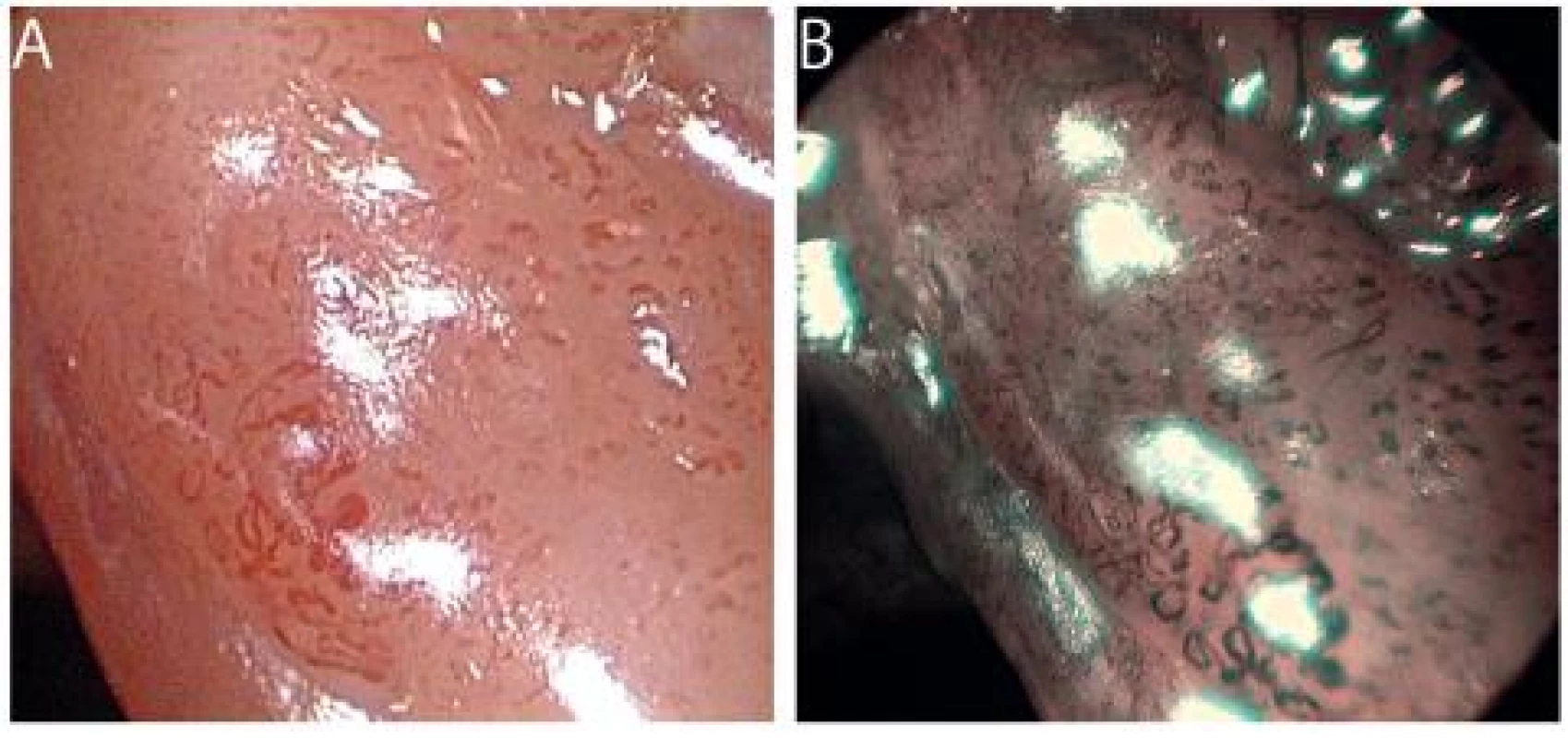 Dlaždicobuněčný karcinom hlasivky v HDTV zvětšovací endoskopii v bílém světle (A) a v NBI (B). Kompletní rozpad cévní mikroarchitektury a nepravidelnosti IPCL jsou charakteristické pro karcinom.