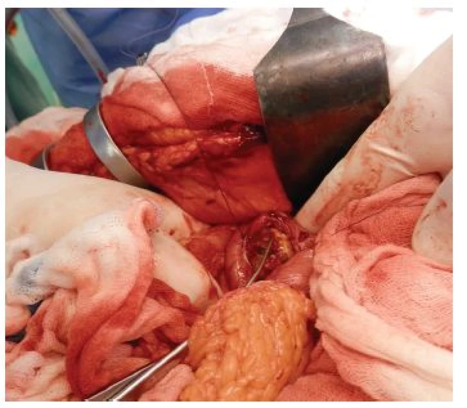 Odstranění žlučového kamene z příčné gastrotomie
Fig. 5: Extraction of the gallstone through a transverse gastrotomy