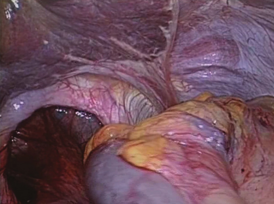 Defekt v bránici po repozici žaludku
Fig. 14: Diaphragm defect after reposition of the stomach