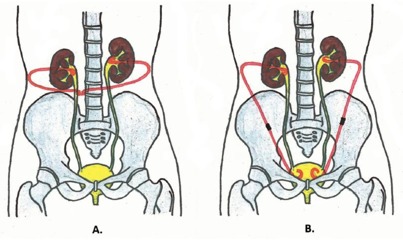 Schéma extraanatomického stentu
A – oboustranný nefrokutánní bypass; B – oboustranný nefrovezikální bypass
Fig. 1. Scheme of extra-anatomic stent
A – bilateral nephocutaneous bypass; B – bilateral nephrovesical bypass