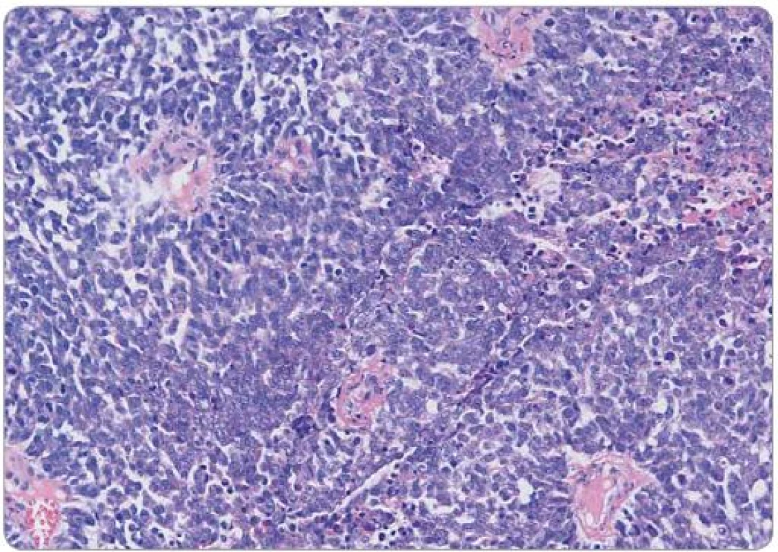 Histologický obraz Ewingowa sarkomu děložního čípku, barvení hematoxylin-eosin, původní zvětšení 200×. Solidní růst uniformních malých buněk, je patrna tvorba pseudorozet v perikapilární lokalizaci.