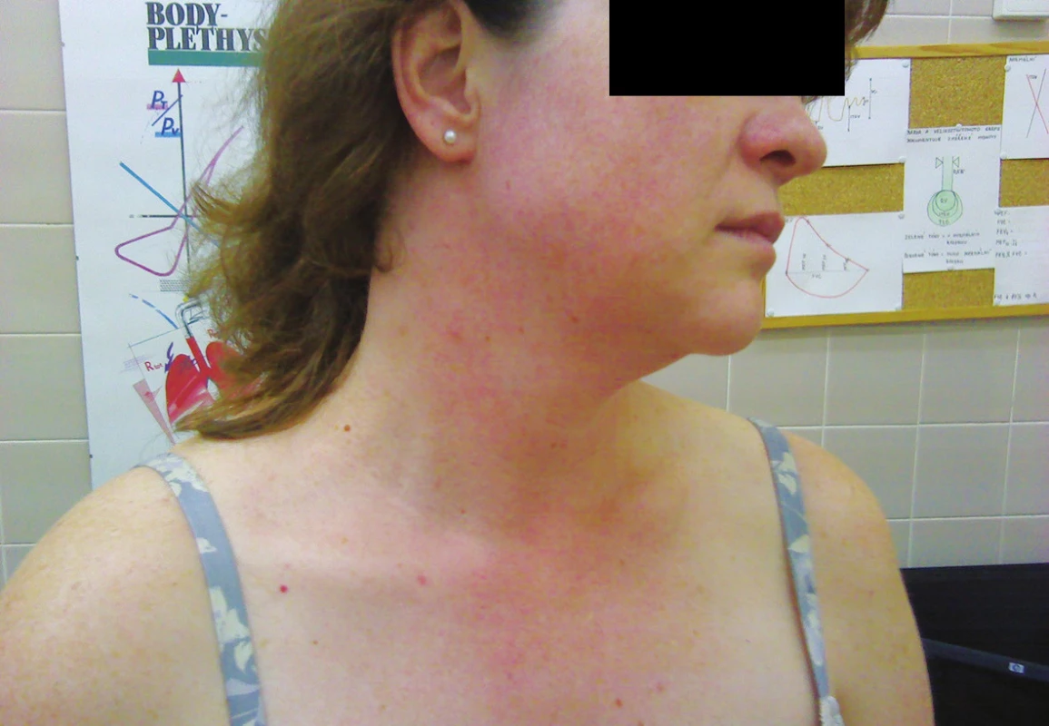 Snímek erytému na krku a v obličeji po provedení expozičního testu
