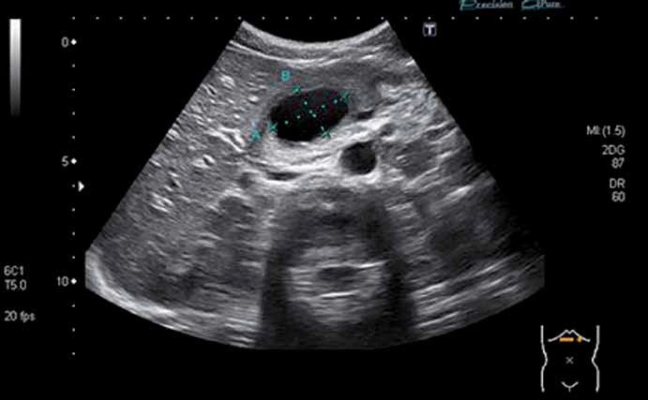 Sonografický obraz potraumatické pseudocysty (36 × 25 mm) v oblasti hlavy pankreatu.
Fig. 6. The abdominal ultrasonography showing the posttraumatic pseudocyst (36 × 25 mm) of the pancreatic head.