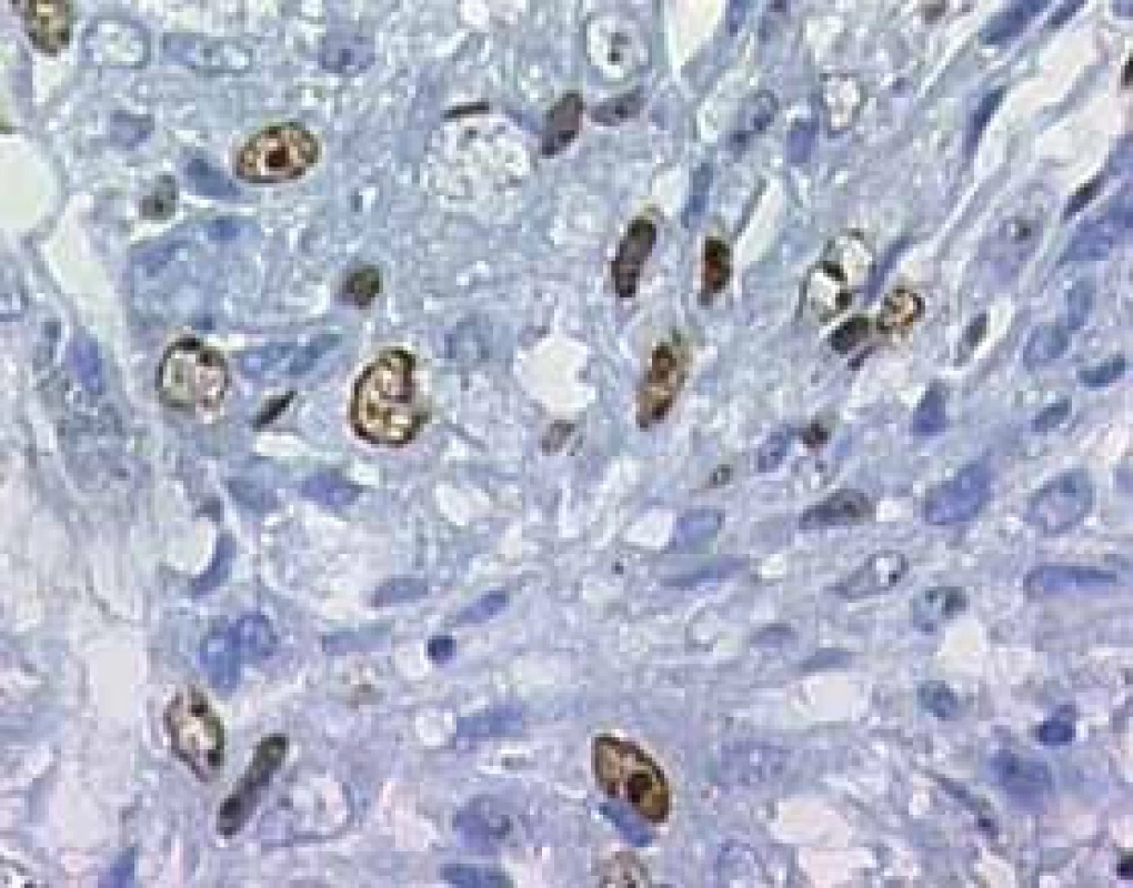 Uroteliální karcinom, vyšetření míry exprese Ki-67, zvětšení 200×
Fig. 2. Urinary bladder carcinoma, immunohistochemistry of Ki-67, 200×