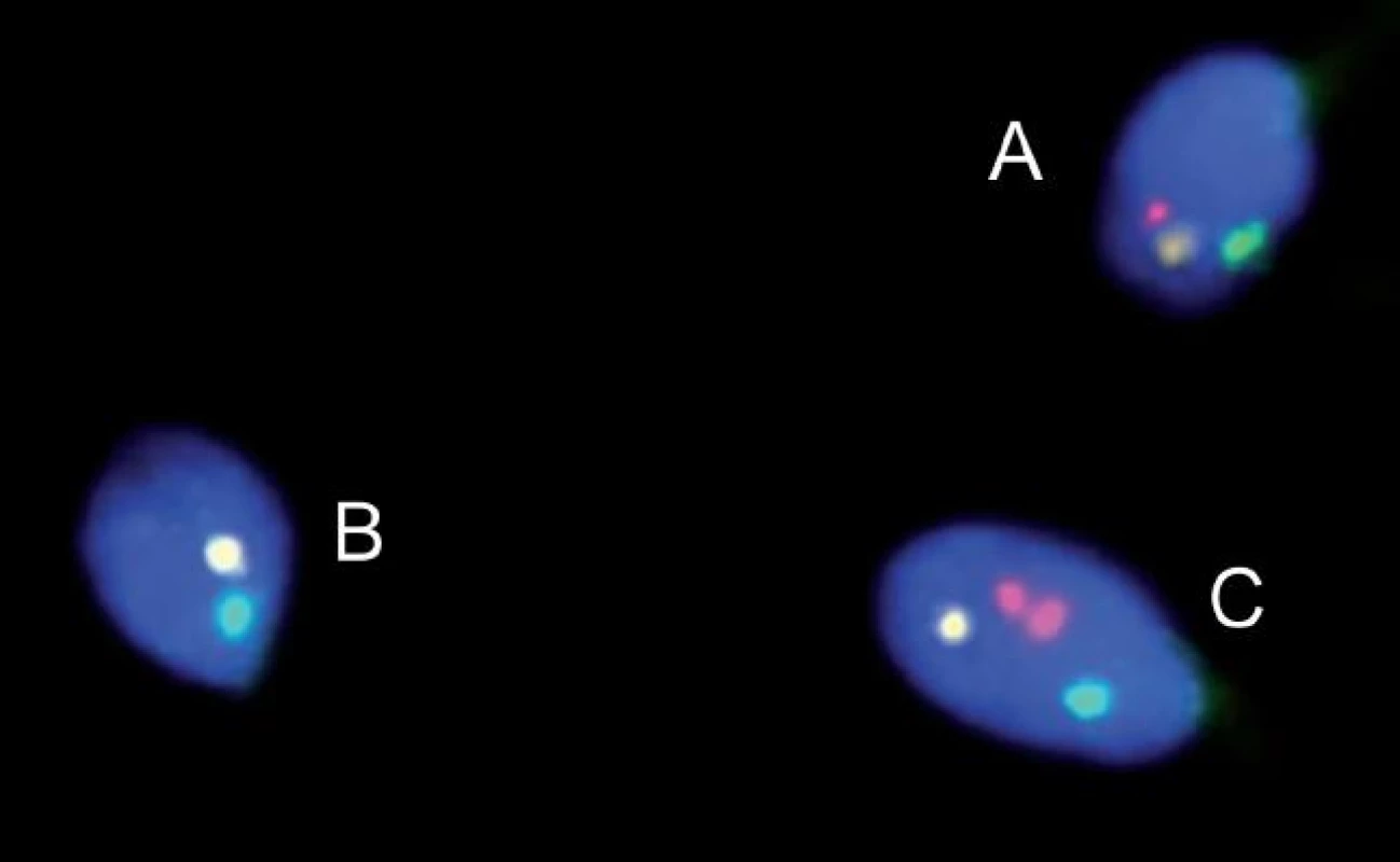 FISH u pacienta s reciprokou translokací. Spermie normální/balancované (A) a nebalancované (B, C).