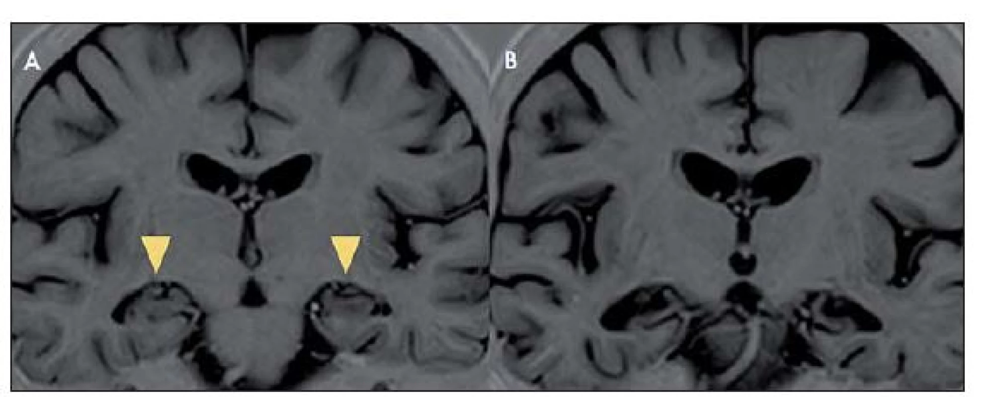Vývoj MR obrazu limbické encefalitidy v čase.
