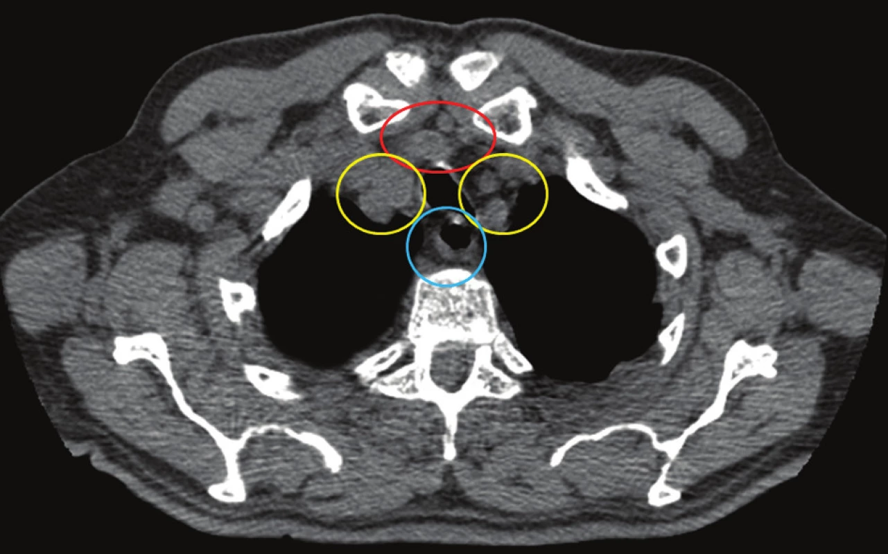 Šíření infekce na krku probíhá ve třech anatomických prostorech
Fig. 3. Spread of infection on the neck concerns three anatomical spaces