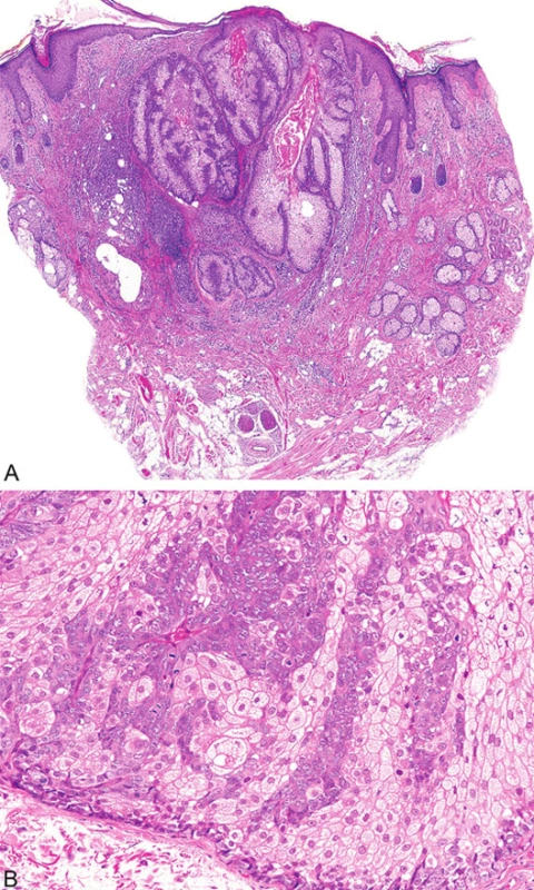 Sebaceózní adenom tvořený několika lobuly pyriformního tvaru spojené s epidermis (A); jednotlivé lobuly jsou složeny z periferní vrstvy tvořené několika řadami malých bazaloidních germinativních buněk a z centrálně uložených zralých sebocytů s objemnou, narůžovělou, pěnitou až jemně vakuolizovanou cytoplazmou (B)