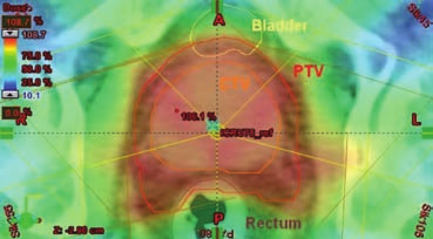 Izodozový plán – radioterapie s modulovanou intenzitou (IMRT) 
Fig. 7 Isodose plan – intensity-modulated radiation therapy (IMRT)
