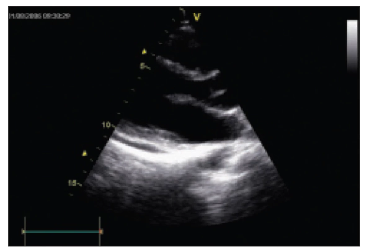 Echokardiografický nález u pacientky 3, nevýznamné množství periakrdiálního výpotku za zadní stěnou levé komory. Parasternální dlouhá osa, 2rozměrné zobrazení.