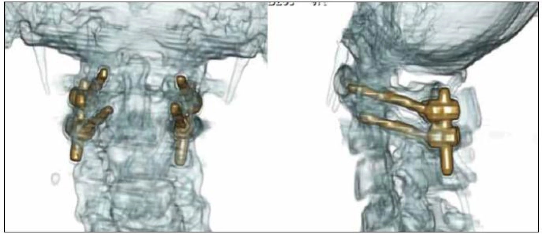 3D CT rekonstrukce po stabilizaci C1/C2 technikou polyaxiálních šroubů a tyčí dle Harmse et al s naložením kostního štěpu mezi oblouky C1/C2, pooperační kontrola.