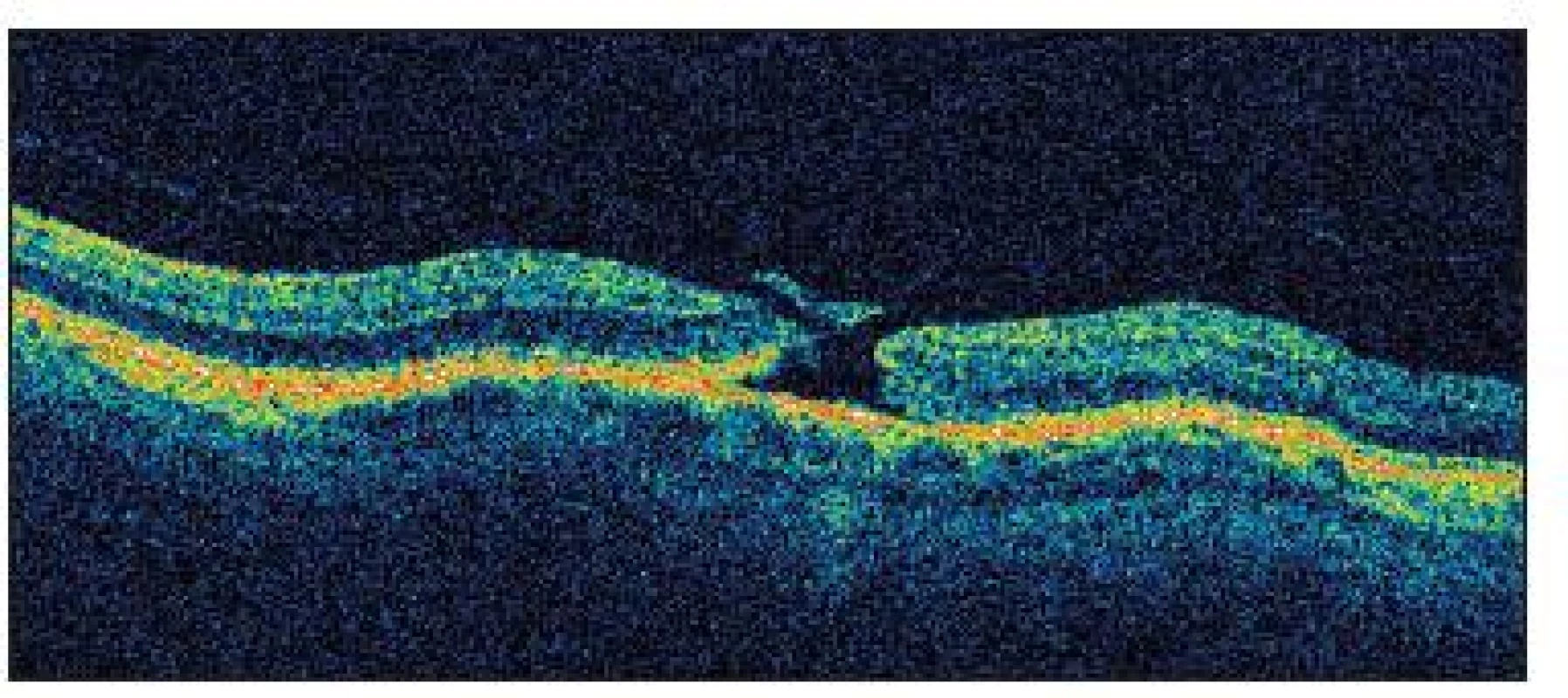 OCT nález diery makuly s pseudooperkulom v štádiu II u pacienta č. 1 v deň operácie katarakty