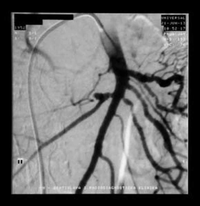 Selektívna angiografia arteria mesenterica superior (AMS) ukázala pseudoaneuryzmu vetvy AMS (biela šípka).
Fig. 3. Selective angiography of superior mesenteric artery (SMA) showed SMA branch pseudoaneurysm (white arrow).
