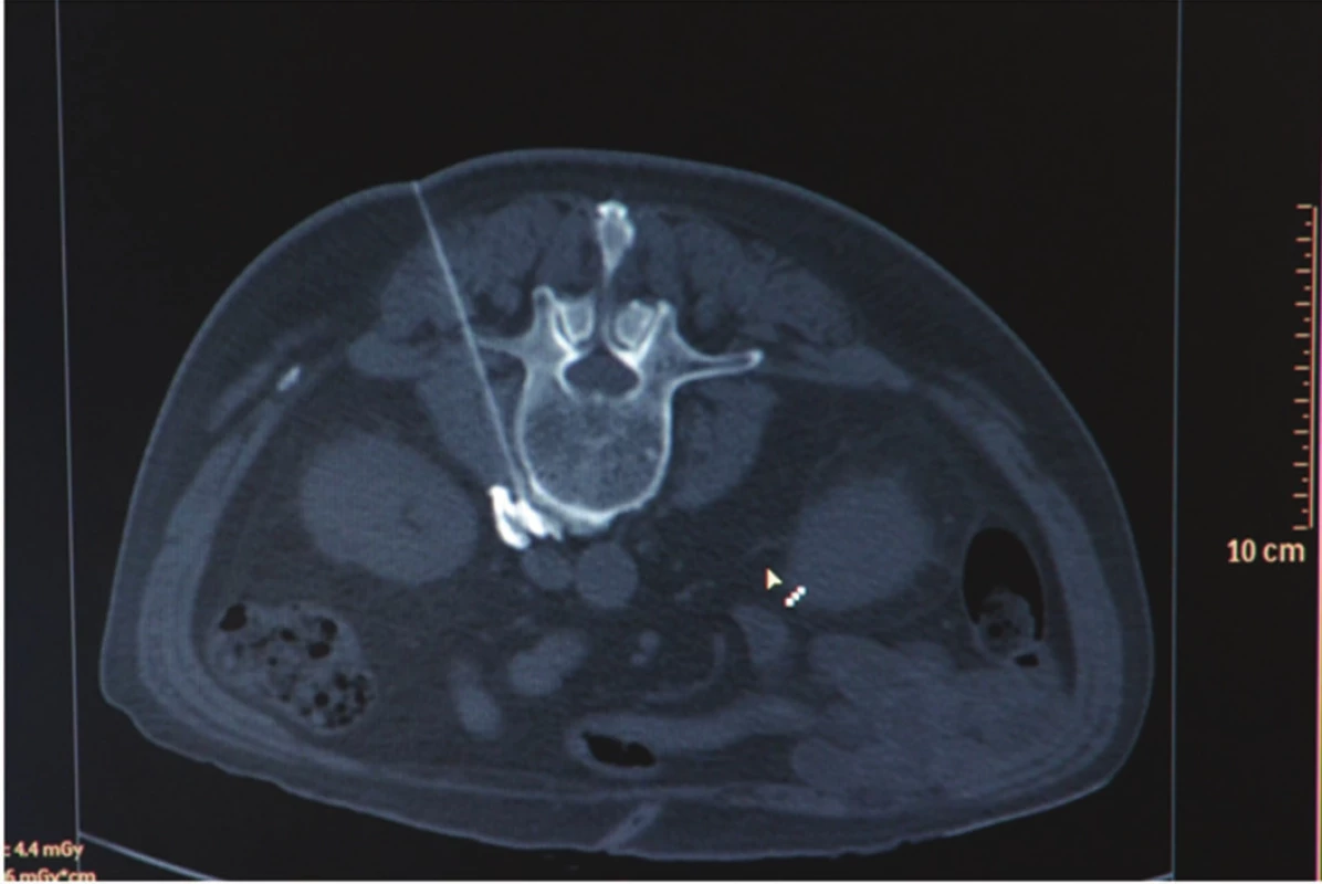 CT navigácia u chemickej LS (stav po zavedení perkutánnej ihly a aplikácii kontrastu)
Fig. 4. CT guided right-side chemical lumbar sympathectomy after percutaneous puncture and aplication of contrast
