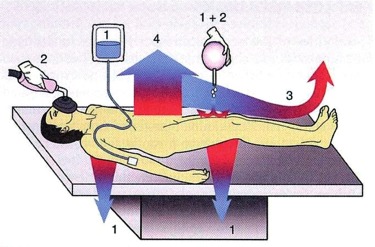 Schéma čtyř způsobů ztráty tepla pacienta na operačním stole