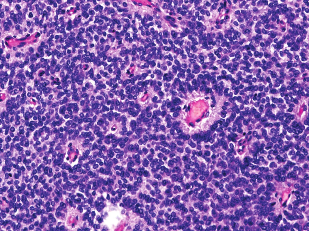 Ewingův sarkom je řazen mezi tumory nejisté diferenciace. Dle nové WHO klasifikace se pro tento maligní nádor již neužívá synonymum primitivní neuroektodermový tumor (PNET) (původní zvětšení 200x).