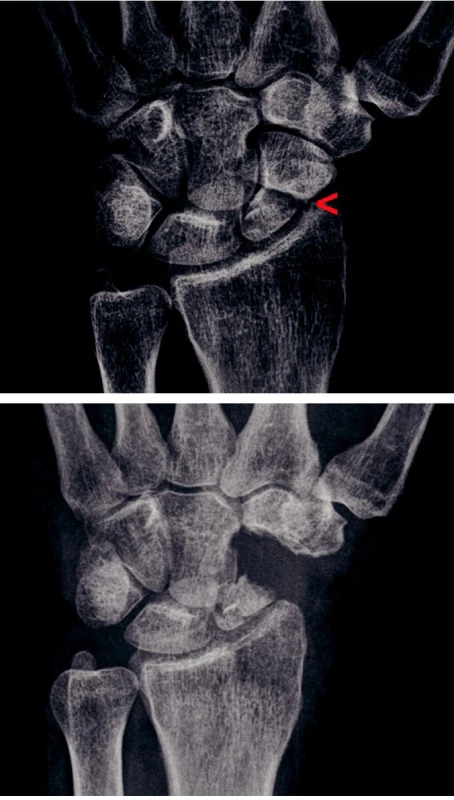 a) Pakloub člunkové kosti s artrotickými změnami typu SNAC III, šipka ukazuje oblast postižení mediokarpálního kloubu se zúžením kloubní štěrbiny a subchondrální sklerózou.
b) Stav po proximální karpektomii s vytvořením neoartikulace mezi os capitatum a fossa lunata distálního radia.