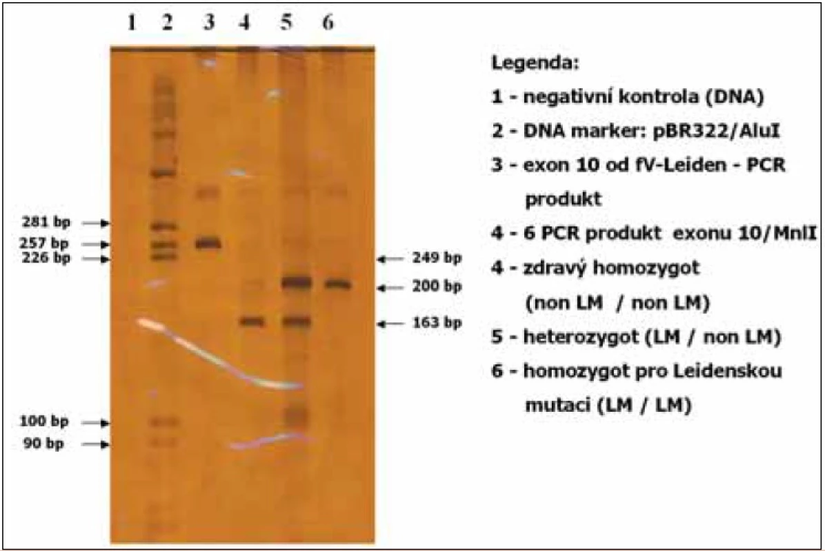 Vyšetření Leidenské mutace v exonu 10 genu pro faktor V, metoda PCR.