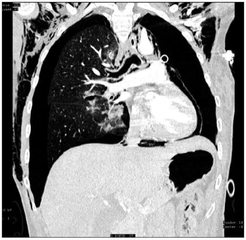 První případ, CT vyšetření asi 14 hod od intubačního poranění, po hrudní drenáži vlevo trvá plicní kolaps, nově i na levé straně, masivní pneumomediastinum a posun mediastina