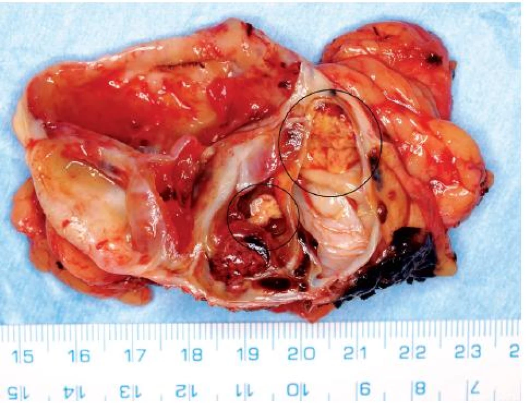 Extenzivně cysticky změněný světlobuněčný renální karcinom s drobnými ložisky solidní tumorózní tkáně (na snímku preparátu označeno)
Fig. 6. Extensively cystic clear RCC with small solid nodules of tumorous tissue