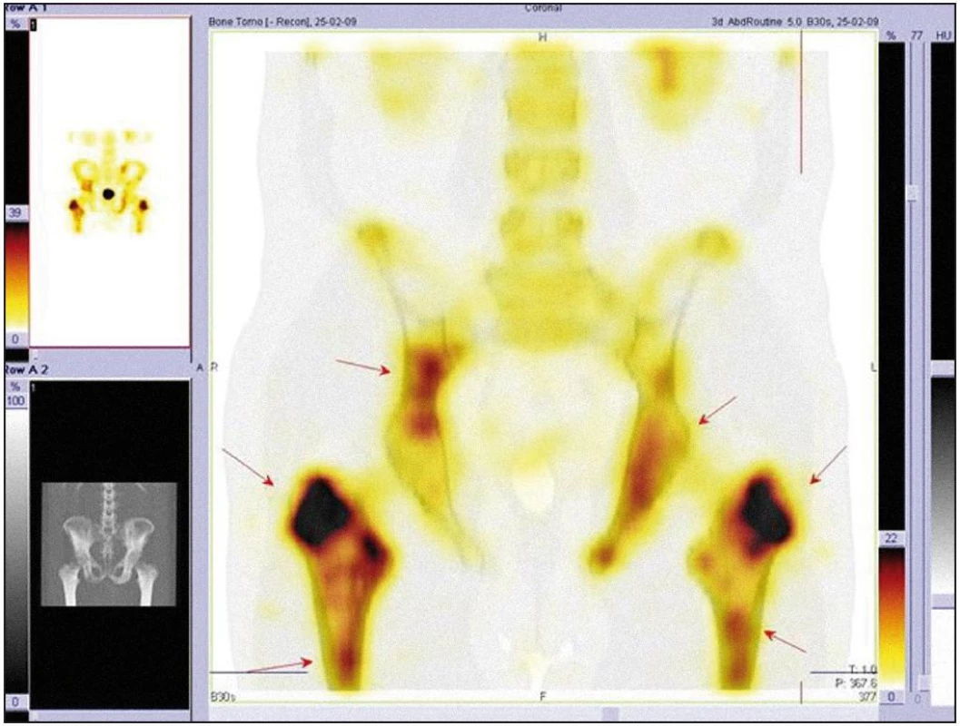 Scintigrafie skeletu, podrobné zobrazení kalvy metodou SPECT. Šipkami jsou označena ložiska zvýšeného vychytávání radiofarmaka.