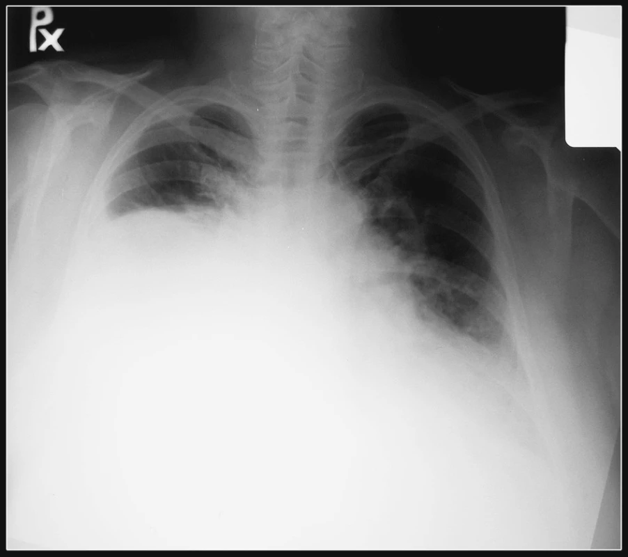 RTG snímka pacienta pred operáciou poukazujúca na zatienenie pravej hrudníkovej dutiny s ostrým ohraničením vo výške tretieho rebra
Fig. 1. The patient’s chest x-ray prior to the procedure, showing a density in the right thoracic cavity with a well-defined outline at the third rib-level