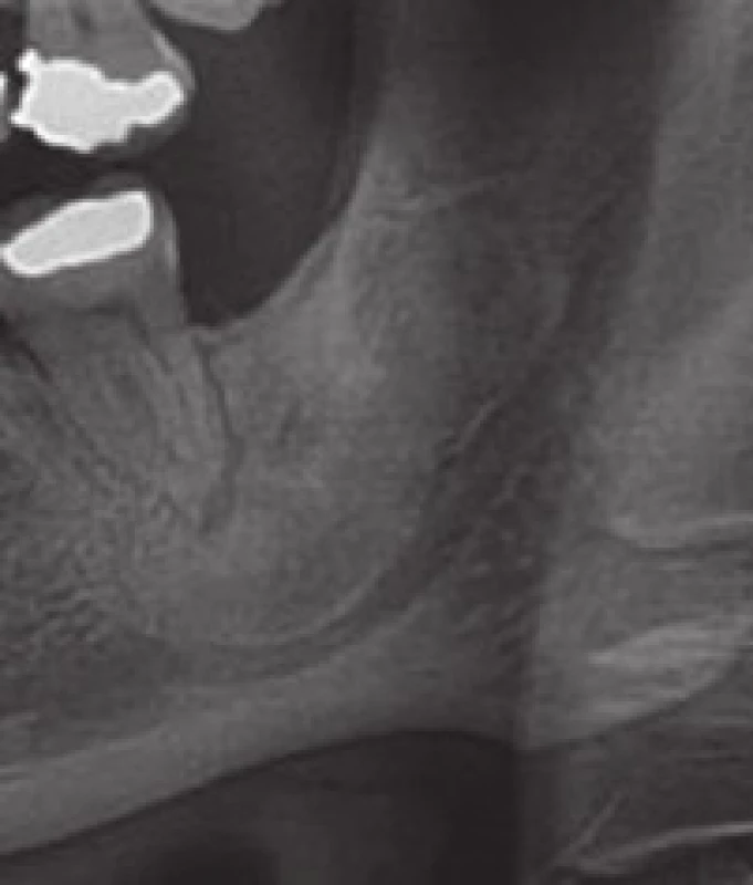 Ortopantomogram zhotovený před exstirpací folikulární cysty (a) a za rok po jejím odstranění (b)