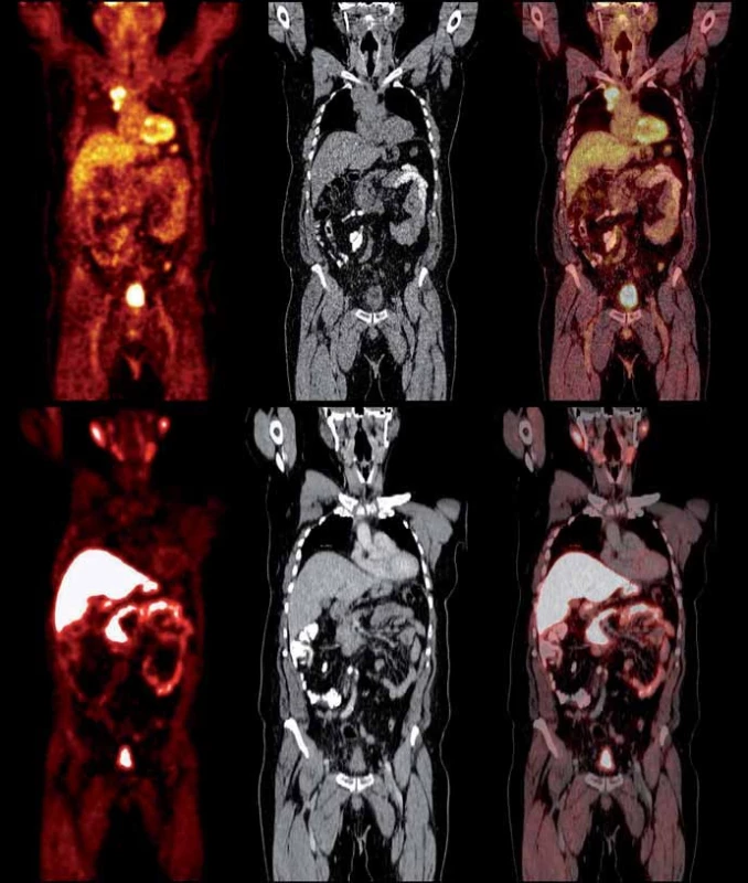 Srovnání PET/CT vyšetření pomocí [&lt;sup&gt;18&lt;/sup&gt;F]FDG (horní řada) a [&lt;sup&gt;18&lt;/sup&gt;F]fluorocholinu (spodní řada) – zleva PET sken, CT sken a fúze – u stejného pacienta s duplicitou tumoru ledviny a karcinomu prostaty. Mediastinální lymfatické uzliny vykazují vysokou akumulaci FDG, nejsou však aktivní na vyšetření [&lt;sup&gt;18&lt;/sup&gt;F]fl uorocholinu, s vysokou pravděpodobností tedy souvisí s nádorem ledviny a nikoliv s karcinomem prostaty.
