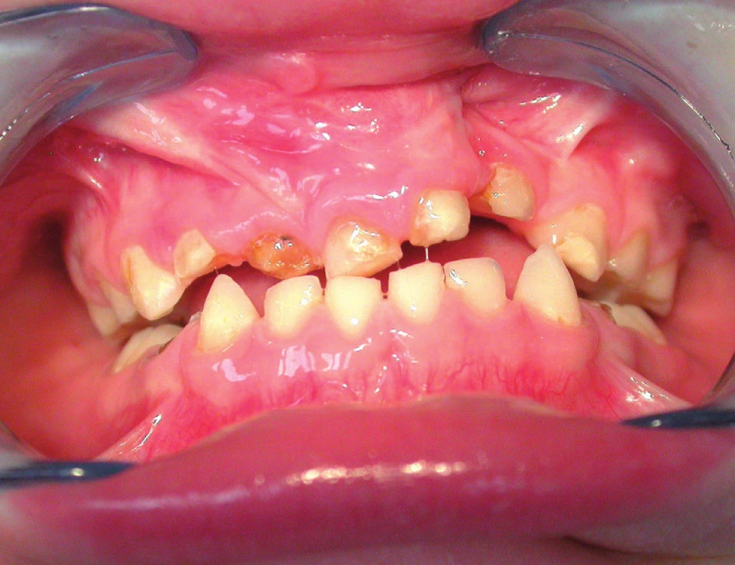 Zubní kaz u batolete s jednostranným rozštěpem rtu, čelisti a patra.
