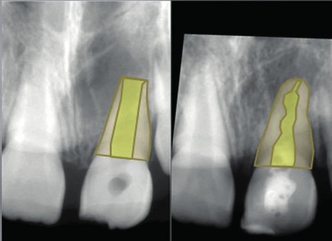 Diagnostický snímek a upravený kontrolní snímek. Na obou je vyznačen rentgenologický povrch kořene (béžová barva).